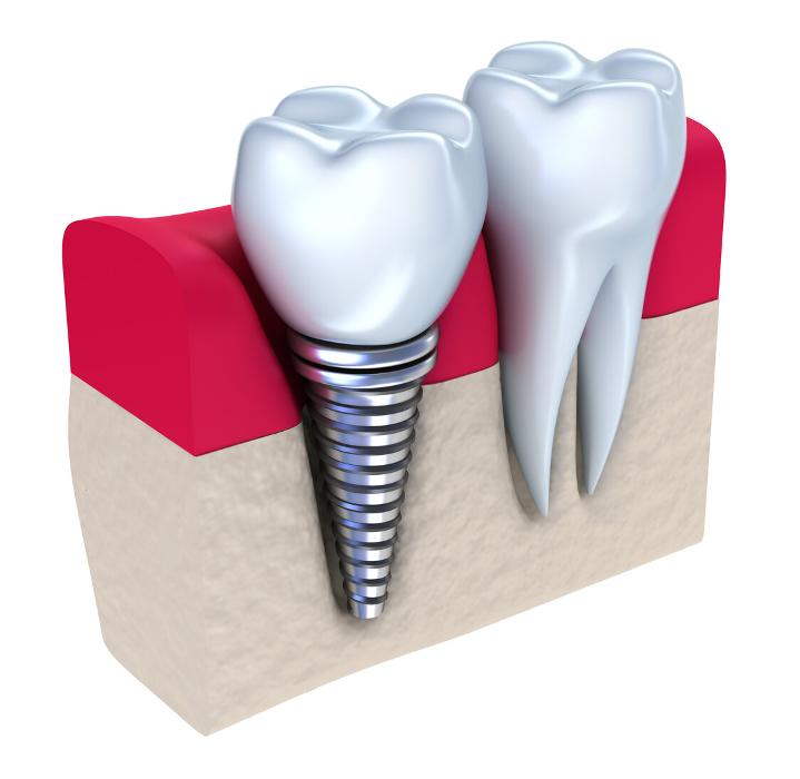 illustration of dental implant