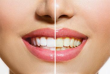 close up of smile before and after whitening
