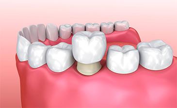 tooth crown in blacktown