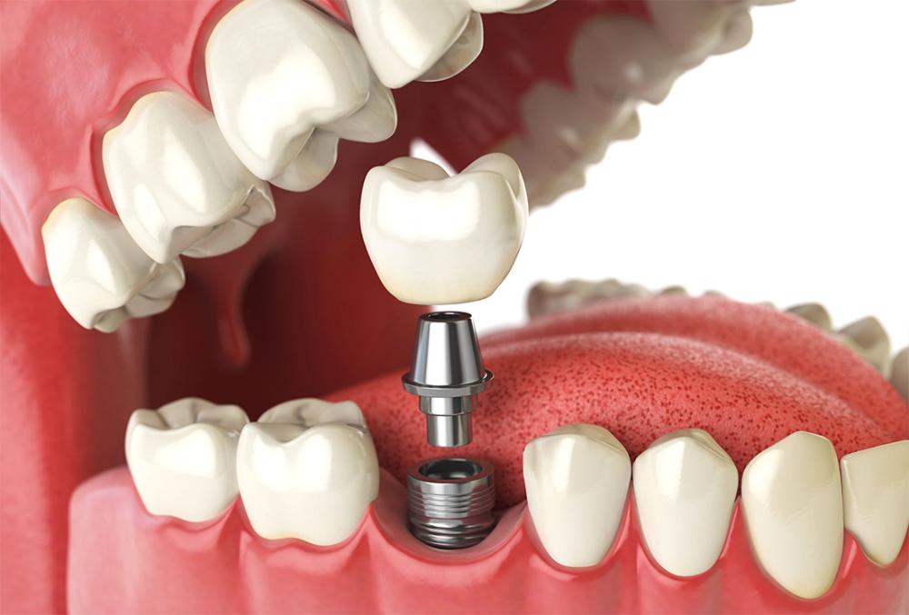 dental implant and crown