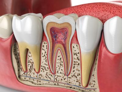 root canal illustration