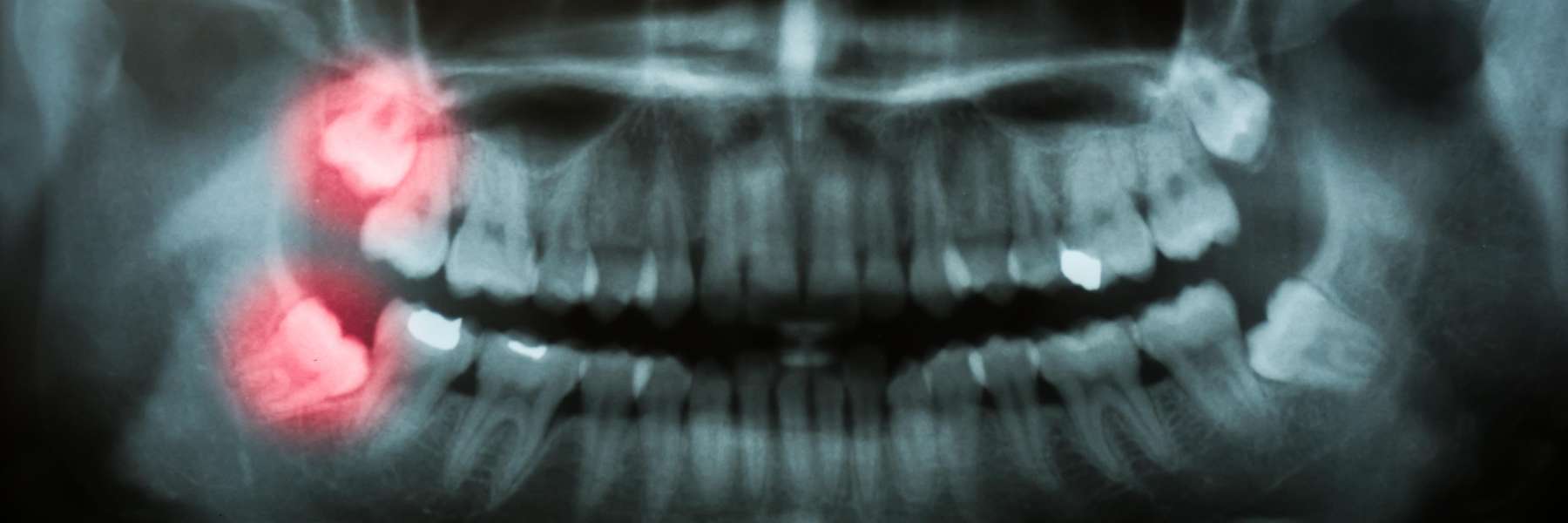 xray showing wisdom teeth