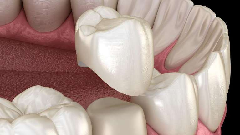 dental crowns blacktown nsw
