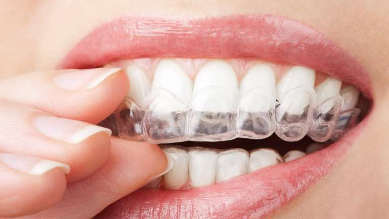 woman putting on invisalign in blacktown nsw