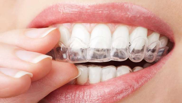 invisalign in the mouth