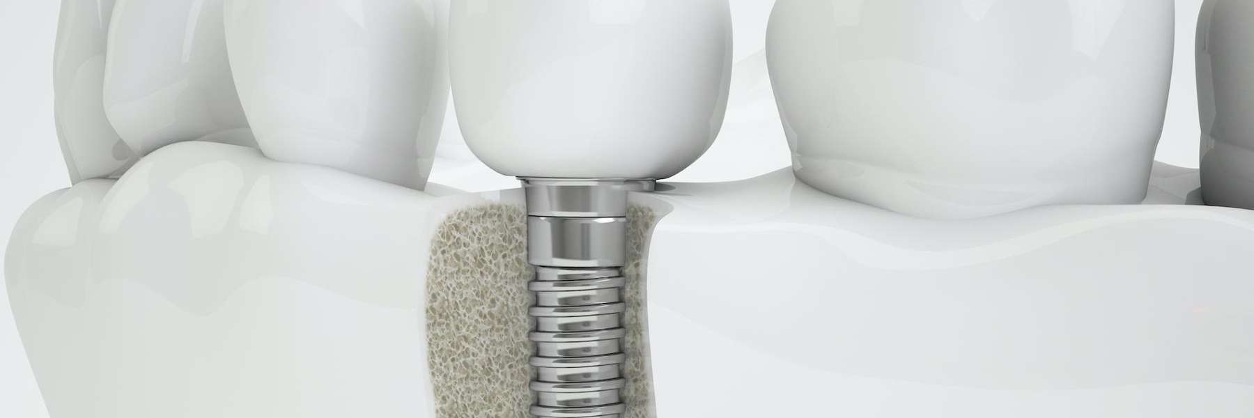 dental implant screw illustration