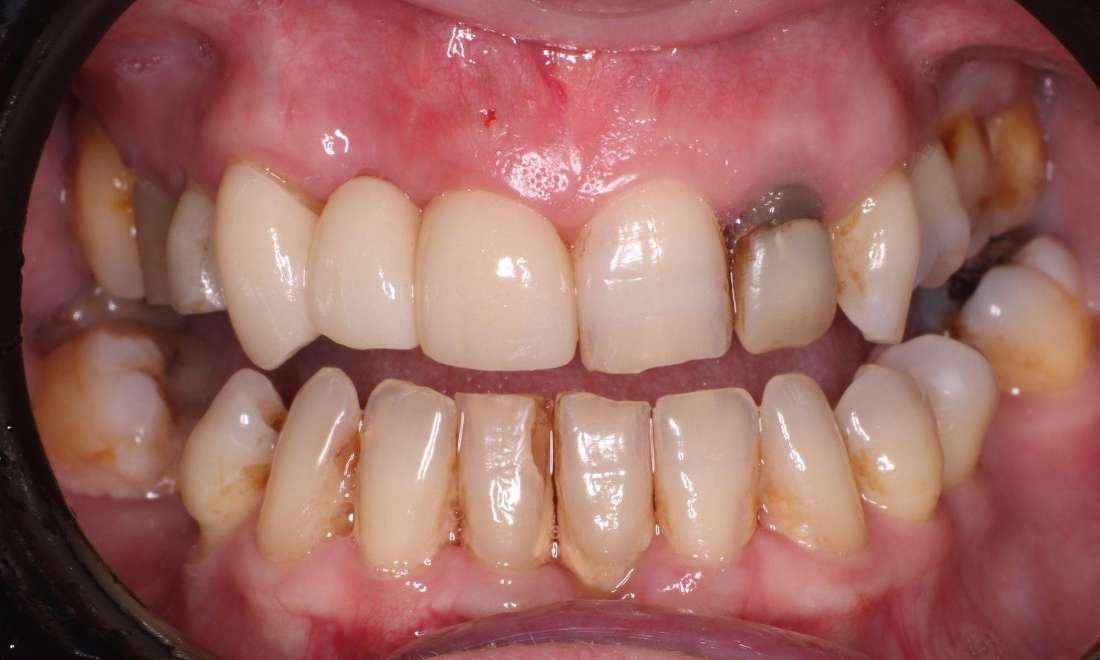 After Dental Bridge