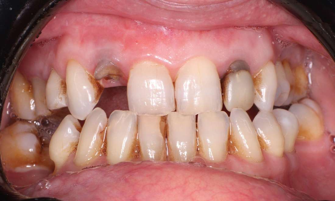 Before Dental Bridge