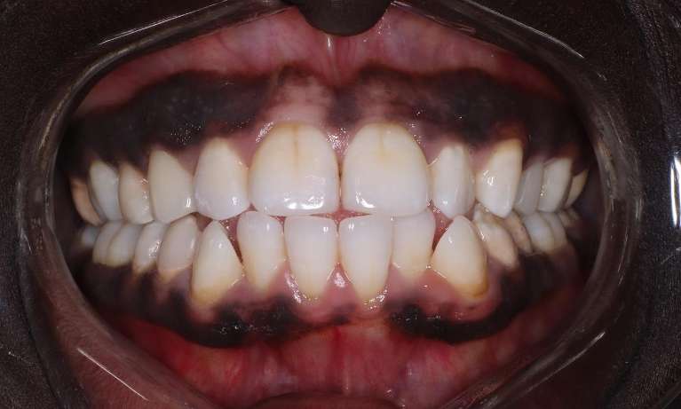 Composite-Veneers-Porcelain-Crowns-After-Image