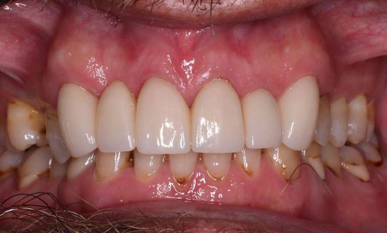 After Crown and Bridge