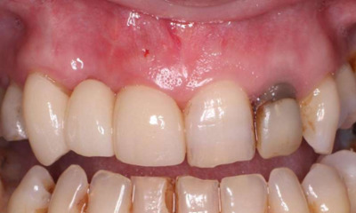 After Dental Bridge