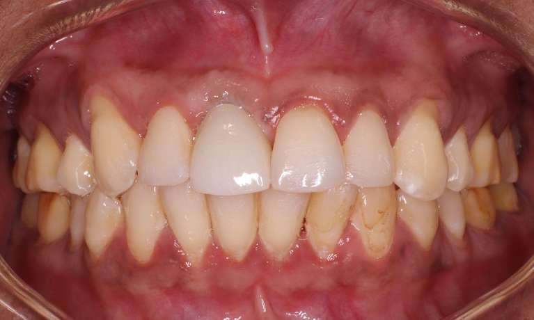 Dental-Implant-After-Image