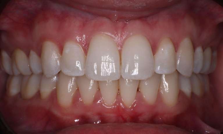 Invisalign-After-Image
