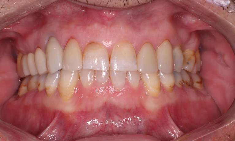 Replacement-of-2-Old-Crowns-After-Image