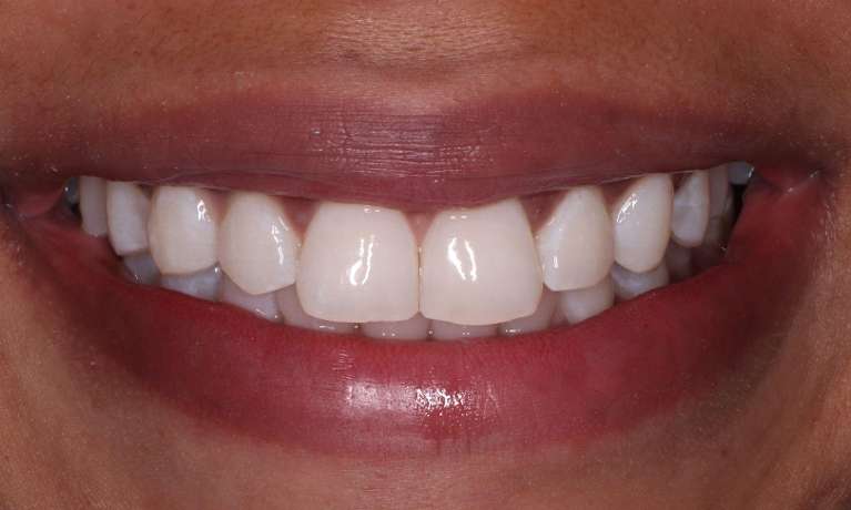 after teeth whitening procedure