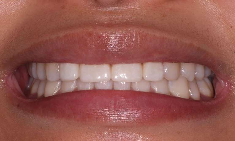 Ceramic-Veneers-After-Image