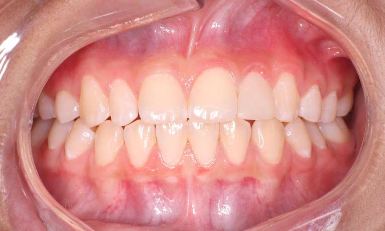 close up of patient's smile after dental bonding