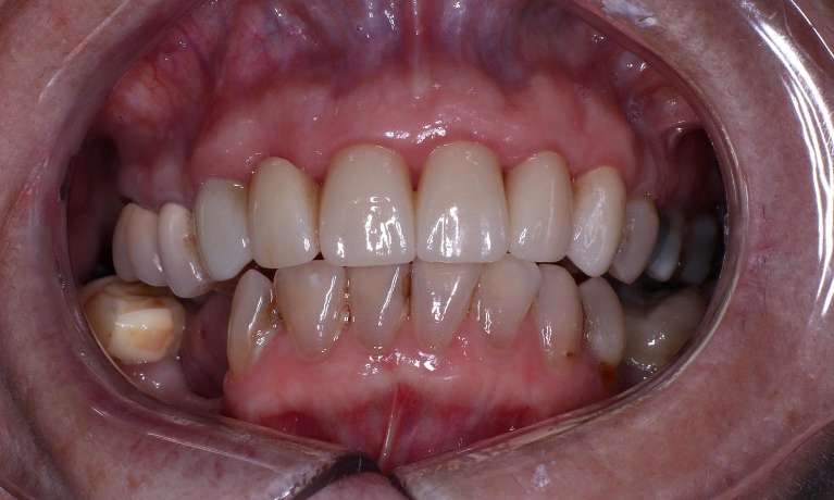 a combination of crowns and bridges used to transform this patient's front teeth