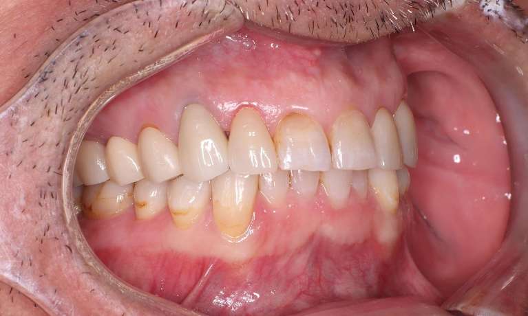 custom-made crowns on patient's two front teeth
