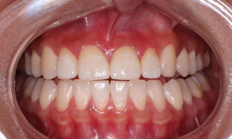 Close Up View on Ceramic Veneers