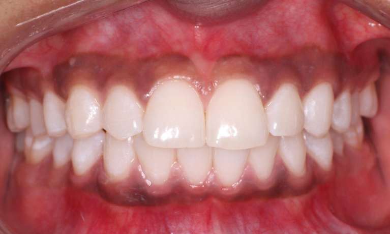 after teeth whitening procedure