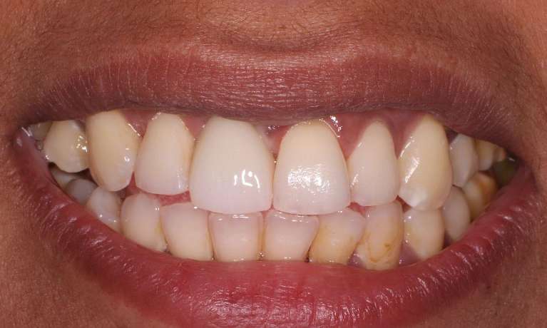 after dental implant procedure