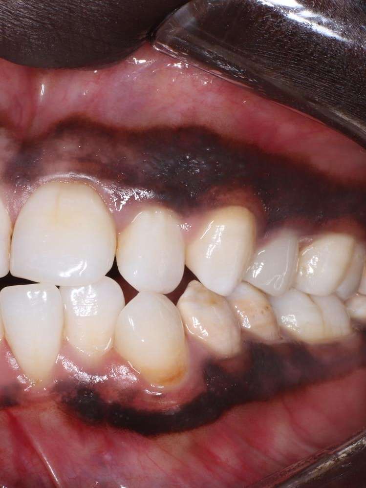 new crowns helped brighten teeth