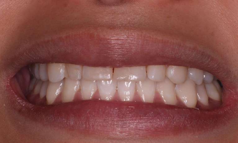 Ceramic-Veneers-Before-Image