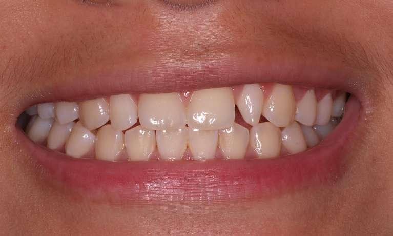 Composite-Bonding-of-Peg-Laterals-Before-Image