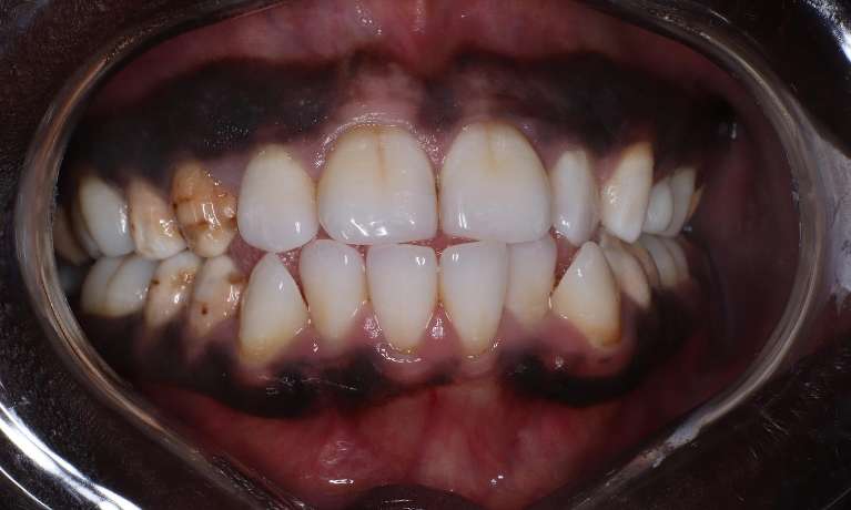 Composite-Veneers-Porcelain-Crowns-Before-Image