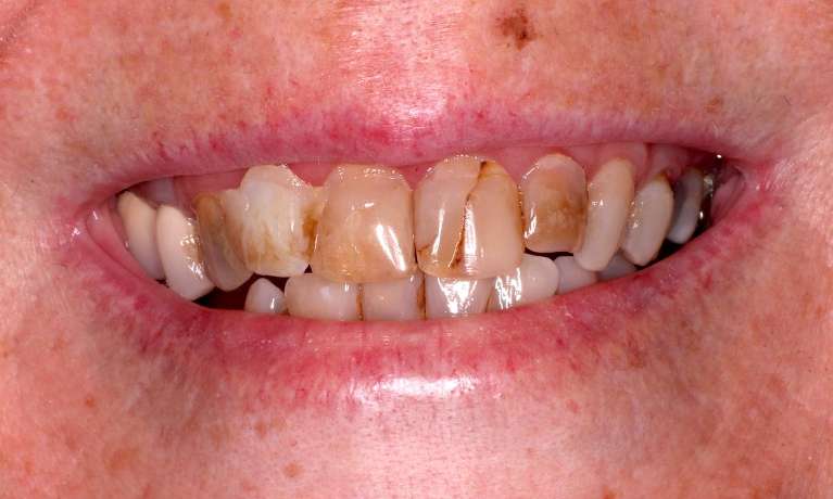 Crown-and-Bridge-for-6-Front-Teeth-Before-Image