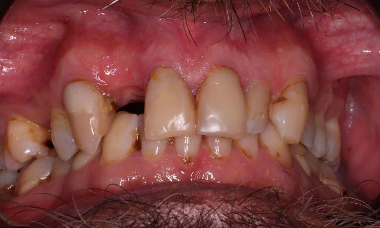 Before Crown and Bridge