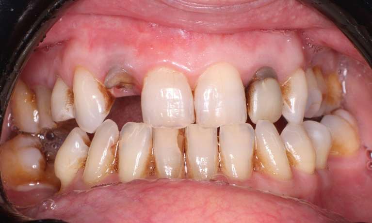 Before Dental Bridge