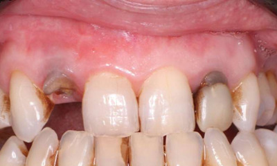 Before Dental Bridge