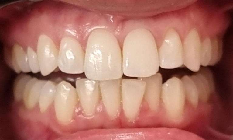 Invisalign-Before-Image