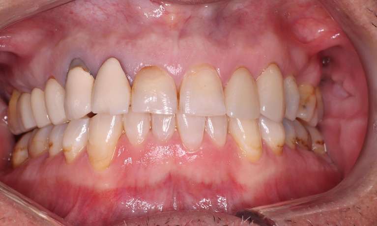 Replacement-of-2-Old-Crowns-Before-Image