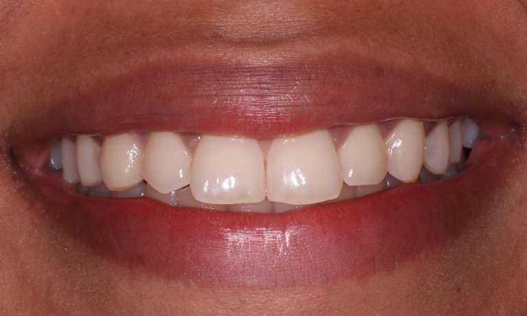 before teeth whitening procedure