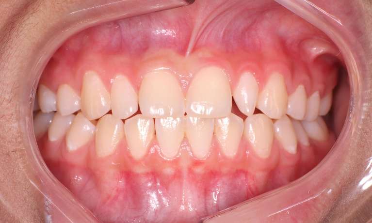 close up of patient's smile with misshapen lateral incisors