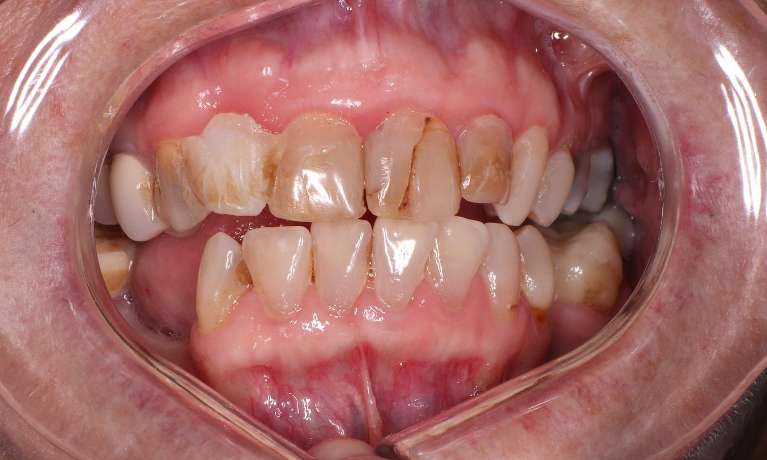 patient with broken down and stained fillings on their front six teeth