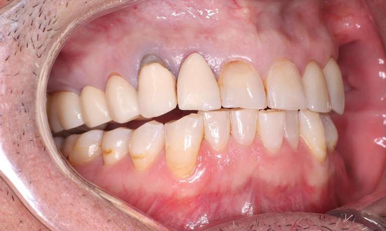 old worn crowns on patient's front two teeth