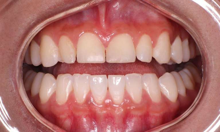 Before Ceramic Veneers in Blacktown NSW