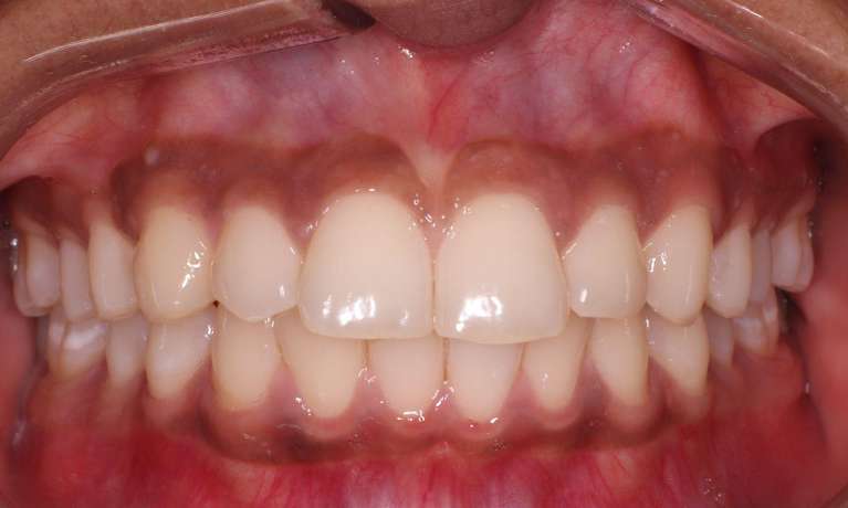 after teeth whitening procedure