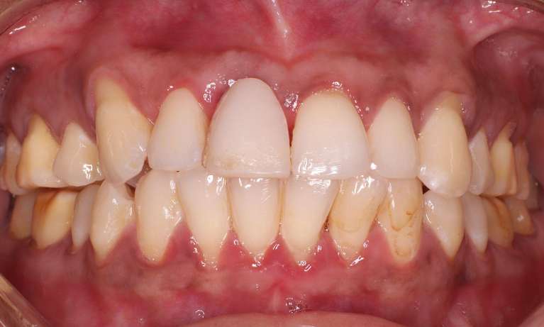 before dental implant procedure