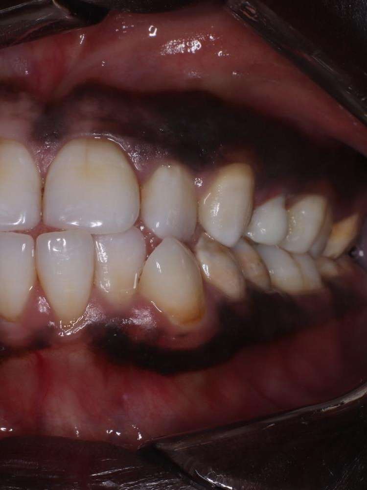 darkened front teeth